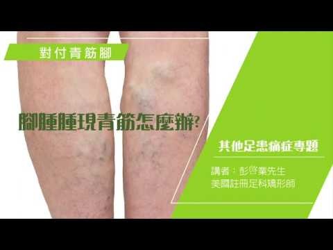 腳腫腫現青筋怎麼辦?–Pedorthic Technology 足科矯形