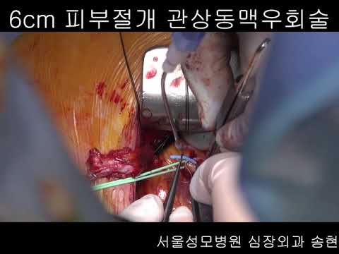 6cm 피부절개 관상동맥우회술 (최소침습 관상동맥우회술) #심장  #Heart #CABG #surgeon