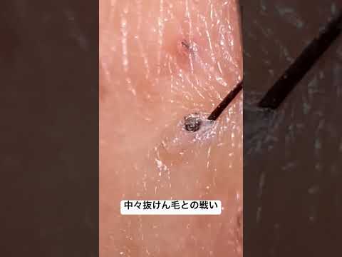 剛毛すぎやしませんかね #毛 #毛抜き #hairpick #blackheads