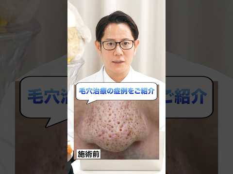 Pore Treatment Case Studies by Hanafusa Dermatology Clinic