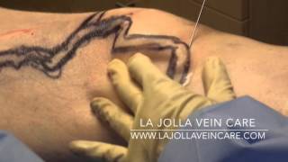 Inside Varicose Vein Surgery: The Phlebectomy Procedure Unveiled