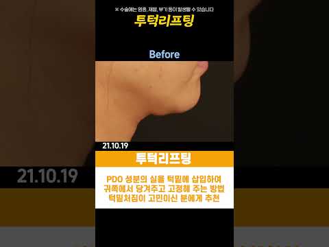 불독리프팅, 투턱리프팅, 초음파윤곽술 차이점