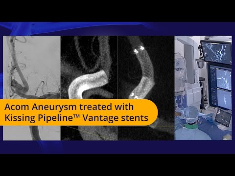 Acom aneuyrsm treated with Kissing Pipeline™ Vantage stents