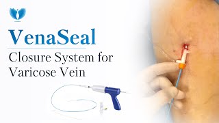 VenaSeal Closure System - Varicose Vein Removal Treatment | VenaSeal Glue Procedure | Process