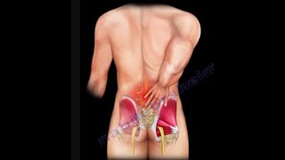 Low Back Pain, causes, diagnosis and treatment.