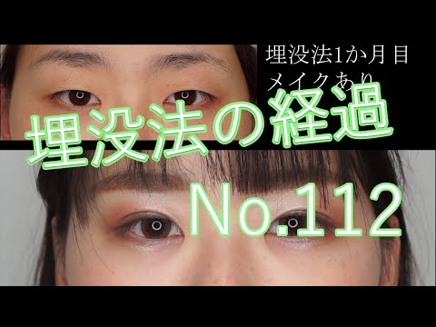 埋没法112　一重まぶたから末広二重へ　モニター手術の経過