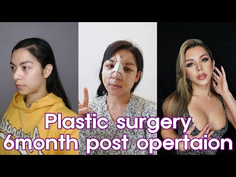 Maxi's surgery update! l Plastic surgery in Korea l Braun Plastic surgery l Facial feminization