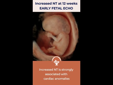 Early Fetal Echocardiography for fetuses with increased NT by Dr Fred Ushakov