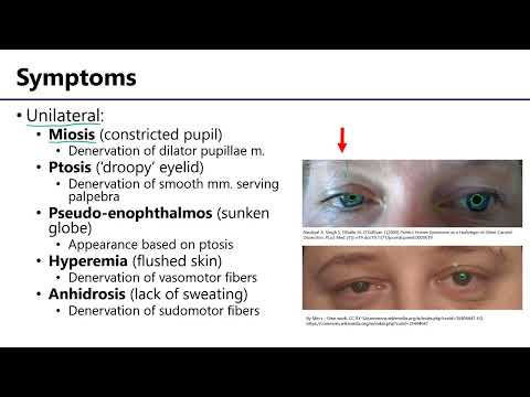 Horner's Syndrome LO4 - M1 Anatomy Learning Objectives