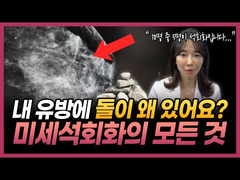 "미세석회화가 유방암으로 간다?" 미세석회화의 모든 것 | 양성석회화, 미세석회화, 유선염