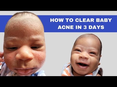 How to Get Rid of Baby Acne Fast | How to Clear Baby Acne in 3 Days | Treating Baby Acne