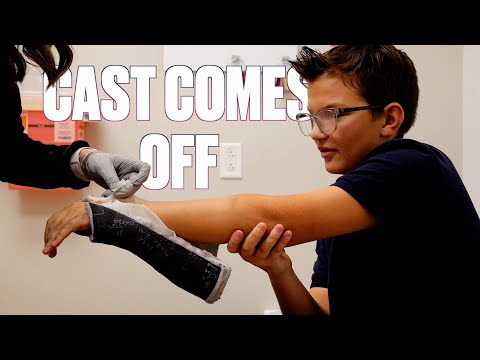 GETTING CAST OFF BROKEN ARM | BOTH ARM BONES BROKEN CAST REMOVED | TAKING OFF BROKEN ARM CAST