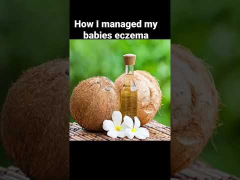 How I managed my Nigeria babies eczema