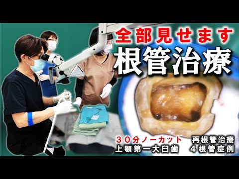 【 全部見せます 】歯の神経の治療のやり直し！３０分ノーカットです！※最後におまけ動画　#歯医者　#宮崎歯科医院　#根管治療