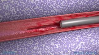 Peripheral IV Phlebitis Animation