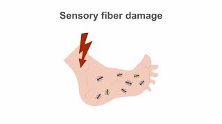 Diabetic Neuropathy: Advanced Management Techniques