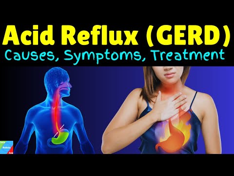 Acid Reflux | GERD | Gastroesophageal Reflux Disease: Symptoms, Causes, Diagnosis & Treatment