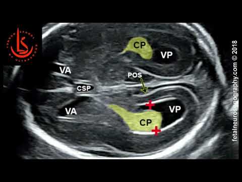 Fetal lateral ventricle measurements: How to measure posterior ventricle for ventriculomegaly