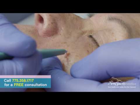 What Is Curetting and How Can It Help You? - Reno Sparks MedSpa - Dr. Calvin Van Reken