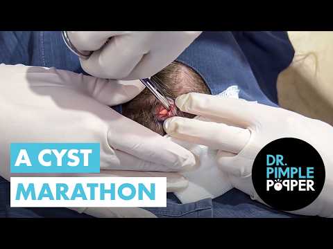 Dr Pimple Popper's Cyst MARATHON!