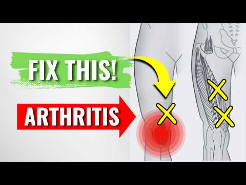 Myofascial Trigger Point Treatment for Knee Arthritis