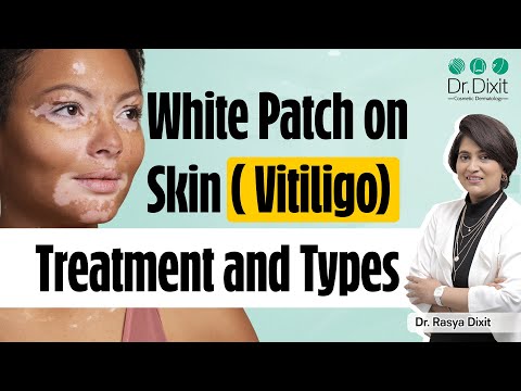 White Patches on Skin | Vitiligo Skin Disease Treatment | Types of vitiligo | Dr. Rasya Dixit