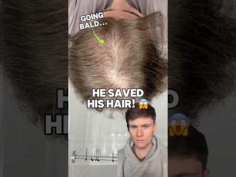 He saved his thinning hair! 😱