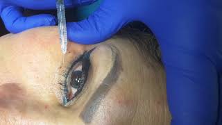 Botox for under eye wrinkles