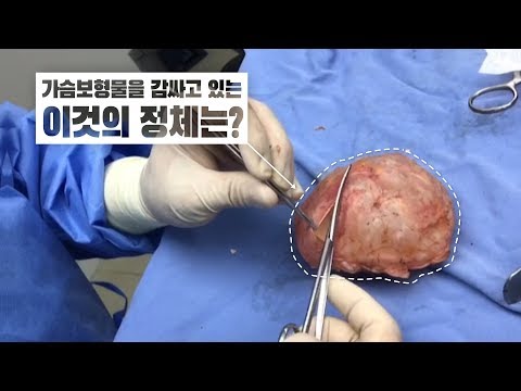 가슴보형물을 감싸고 있는 피막! 그리고 피막완벽제거 피막전절제술!