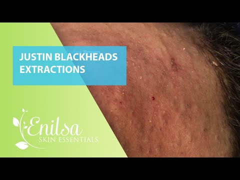 Justin Blackheads Extractions 4th Treatment Part 1