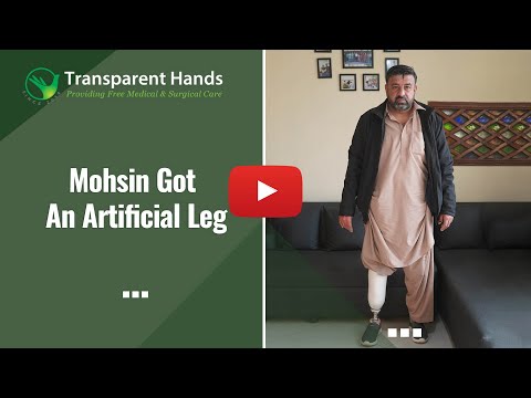 Mohsin Javed got an Artificial Leg | Prosthetic Leg Procedure | Below Knee amputation Case