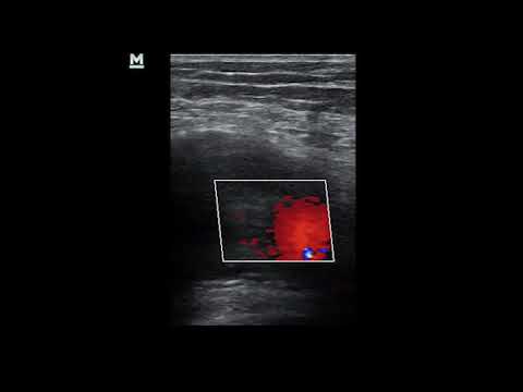 Popliteal artery  aneurysm treated with exclusion and femoropopliteal bypass with  vein graft.