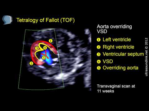 Tetralogy of Fallot (TOF) echo at 11 weeks