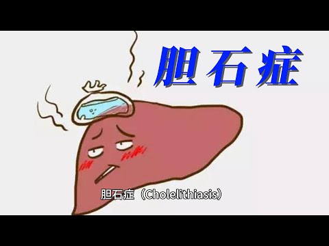 胆石症