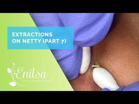 Extracting Blackheads on Netty - Seventh Treatment