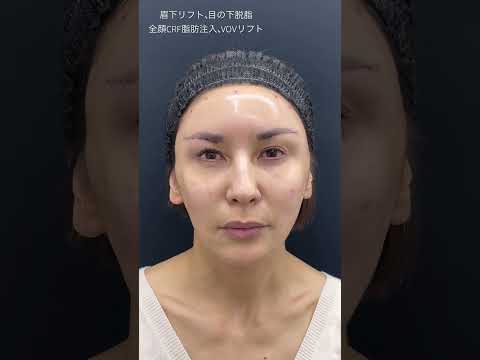 49歳 アラフィフ女性が顔のコケを治療しツヤツヤ卵型フェイスに☆ジェントル式全顔若返りチャレンジ！ #眼瞼下垂 #眉下切開 #全顔脂肪注入