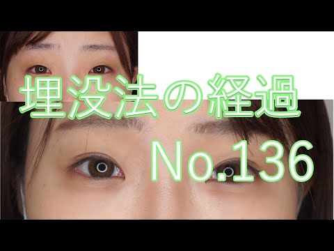 埋没法の経過　136　#short