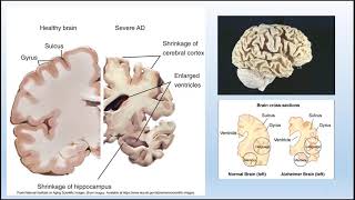 Neurological Disorders