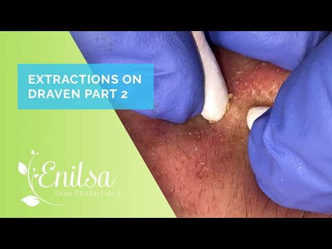 Blackhead Extractions With Draven - Part 2