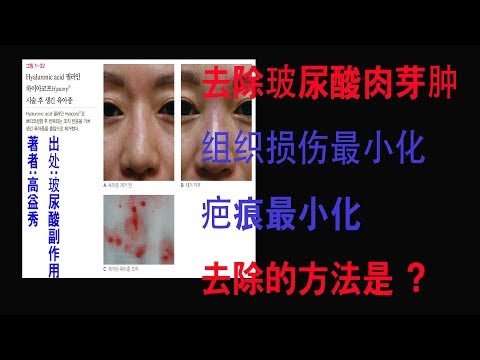 玻尿酸併發症中的玻尿酸肉芽腫的去除方法