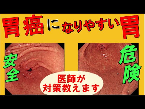 胃癌になりやすい人と、超簡単な予防策！【内視鏡画像見せます】