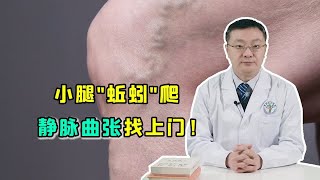 腿上无数“小蚯蚓”爬满了？医生介绍静脉曲张最有效的治疗方式！