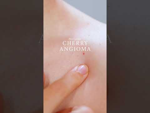 How to Get Rid of Cherry Angiomas | PLASMA PEN REMOVAL PEN REVIEW + DEMO #shorts