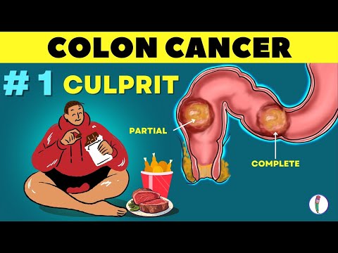 # 1 🔥 Cause of Colon Cancer & how to prevent it | Colon Cancer - causes | Rectal cancer