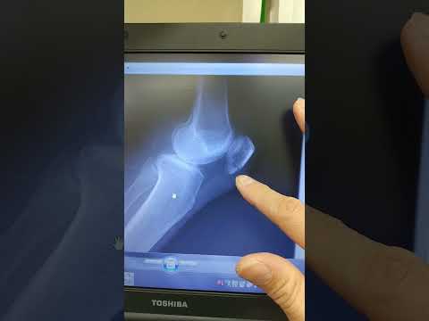 膝蓋骨骨折について　春日部　ときだ接骨院鍼灸院  patella fracture x-ray