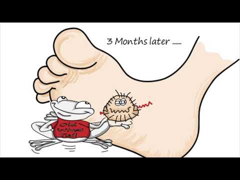 What Are Plantar Warts: Dr  Mikkel Jarman Pediatric Podiatrist