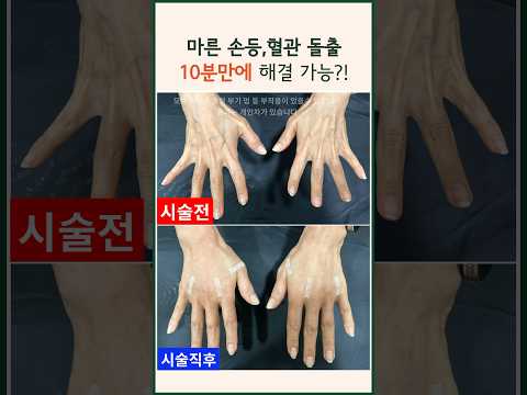 마른 손등,혈관 돌출 10분만에 해결 가능? | 손등필러 지방이식 볼륨 #modsclinic #모즈의원 #손등필러