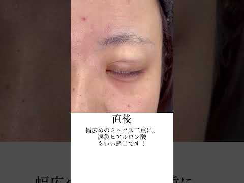 埋没二重＋涙袋ヒアルロン酸