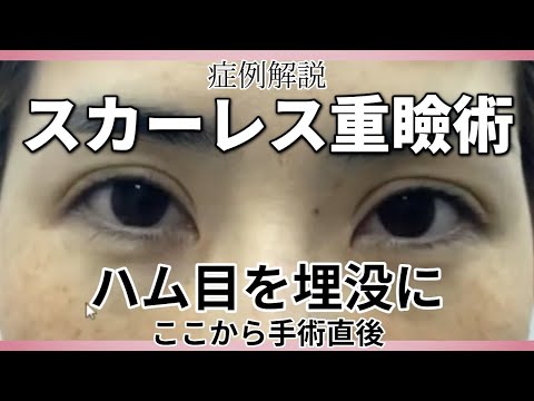 スカーレス二重直後を紹介