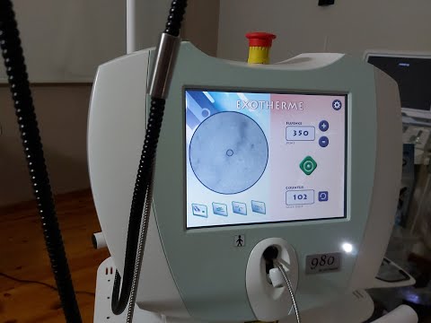 Αντιμετώπιση ευρυαγγειών με Laser (Laser treatment of spider veins)